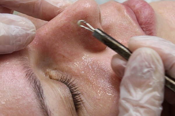 Пилинг лица. Ultra Подарки Нижний Новгород. Подарочный сертификат на натуральную пилинг лица. Ultra Подарки Нижний Новгород. 8 800-505-9503. Пилинг лица  #вМоскве#, чистка лица, очищение лица, химический пилинг